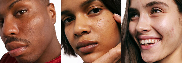 The perfect skin care routine for acne