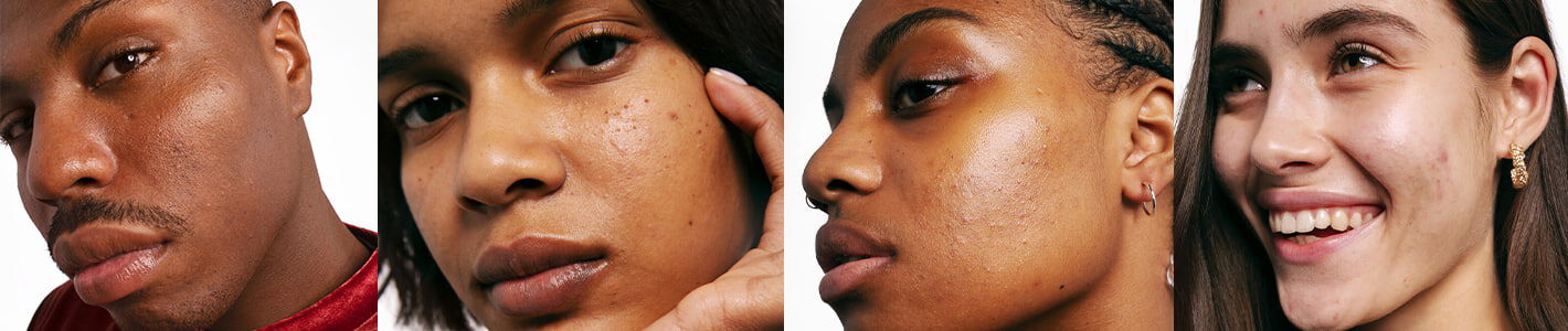 The perfect skin care routine for acne